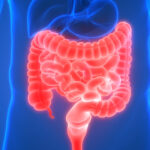 Short Bowel Syndrome: Insights, Challenges, and Management Strategies